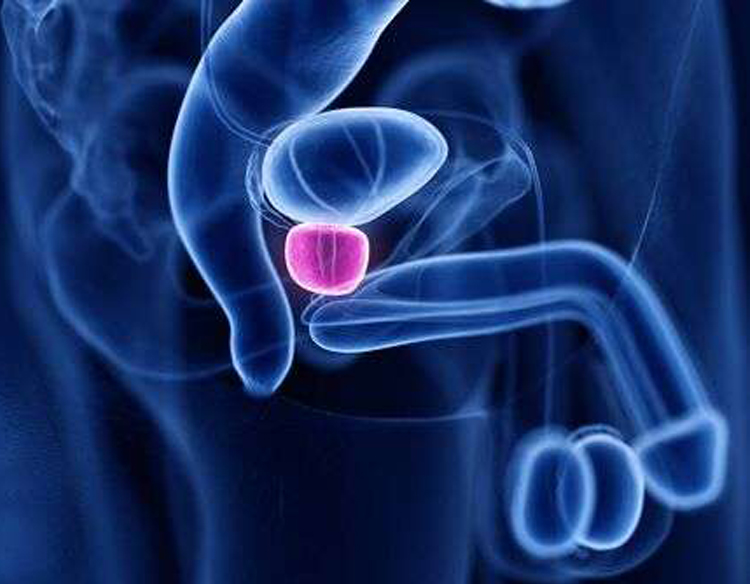 El láser verde y la hiperplasia de próstata