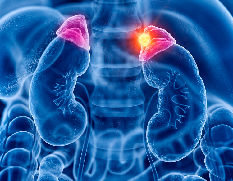 Tumores suprarrenales: desafíos y tratamientos