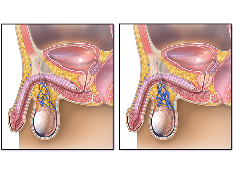 Varicocele e infertilidad masculina