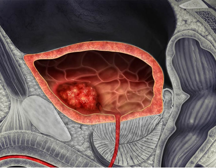 El cáncer de vejiga: factores de riesgo